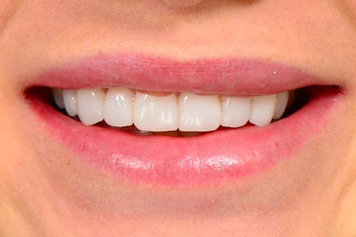 Porcelain Veneers Porcelain Veneers