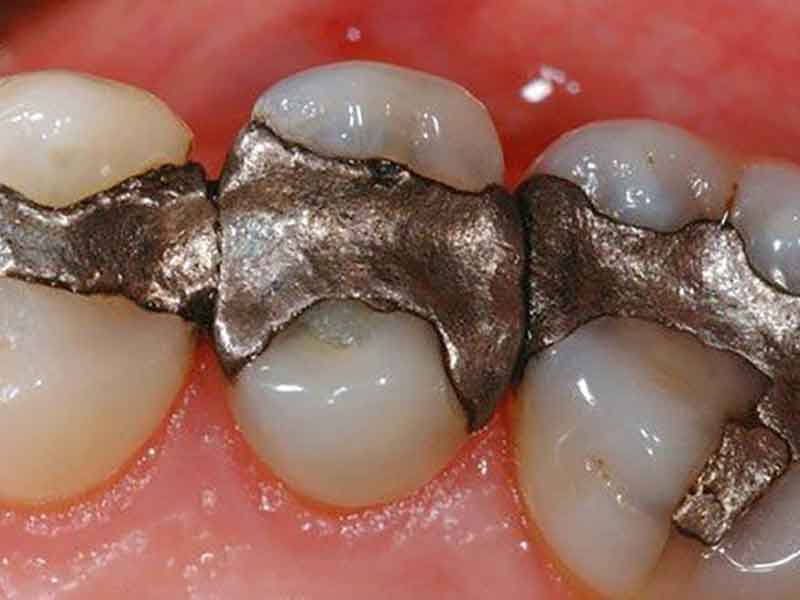 Replacement Of Old Metal Fillings Replacement Of Old Metal Fillings