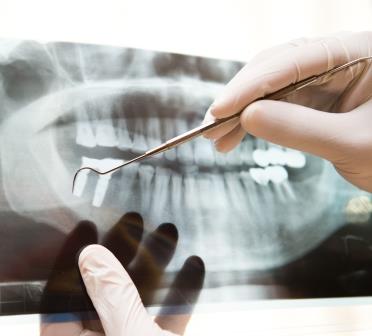 Root Canal Post Op Root Canal Post Op