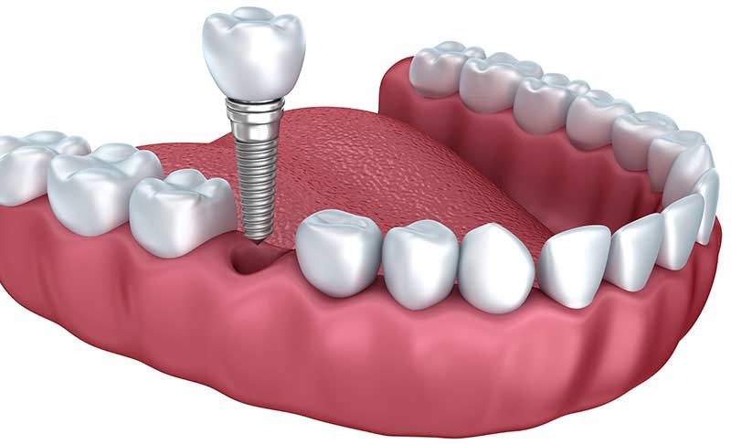Bone Grafting Bone Grafting