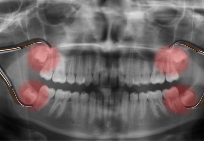 Wisdom Teeth Removal Wisdom Teeth Removal