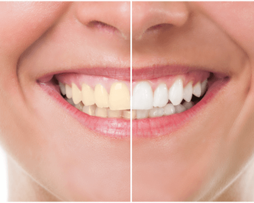 Take Home Teeth Whitening System Take Home Teeth Whitening System